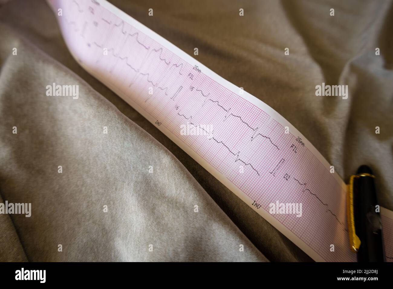 Electrocardiogram with a cardiac arrhythmia on a patient's bed. Study