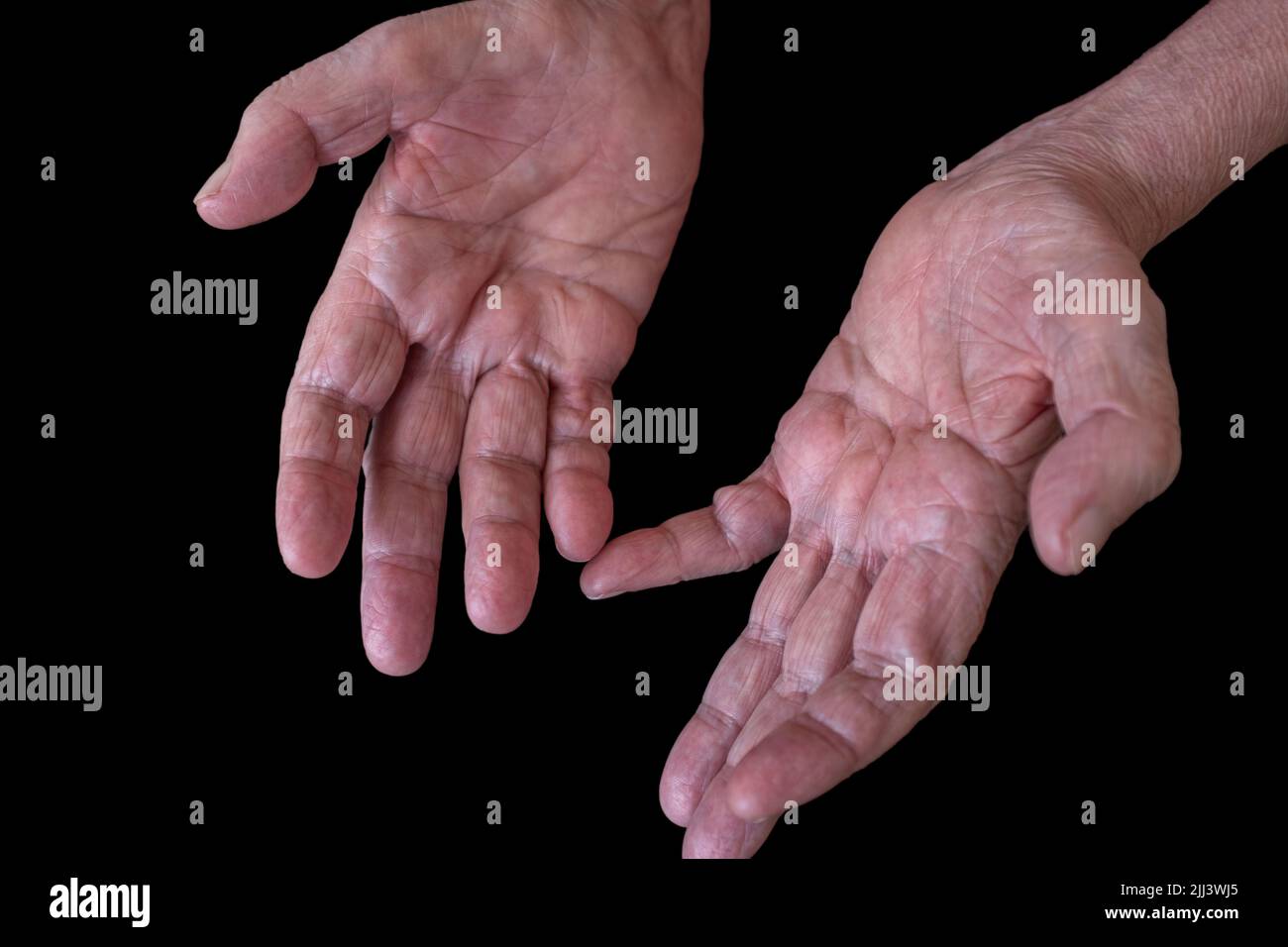 Close-up of the hands of an elderly man with CIDP (Chronic Inflammatory Demyelinating Polyneuropathy) an autoimmune disease of the nervous system. Stock Photo
