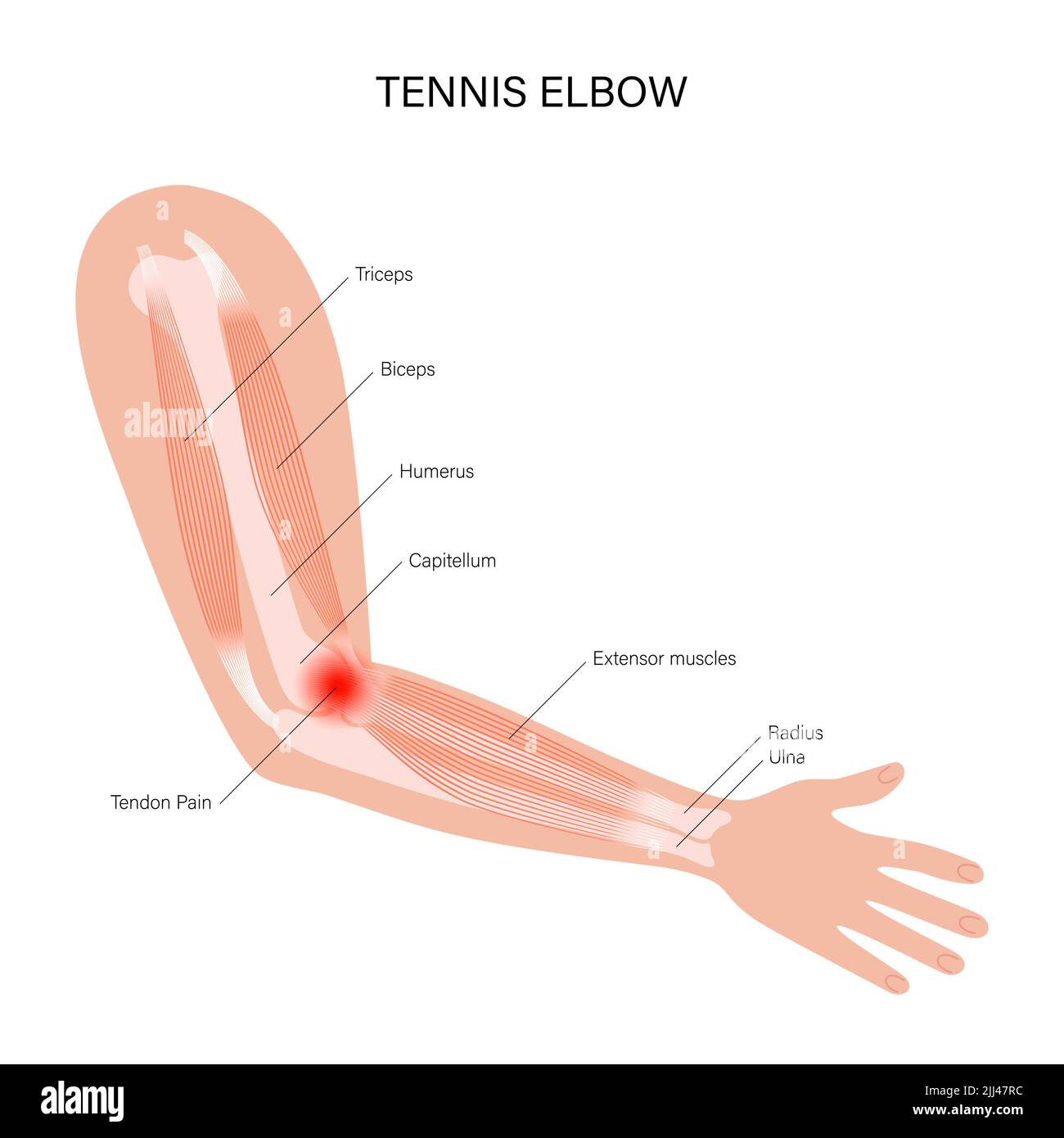 Illustration Of Tennis Elbow Or Lateral Epicondylitis Stock Photo Alamy