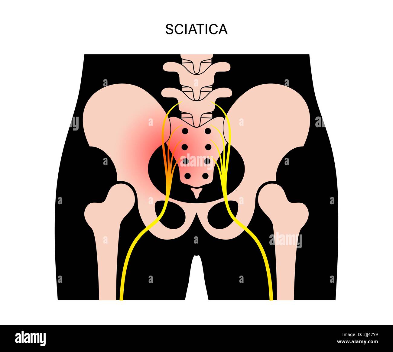Sciatica diagram hi-res stock photography and images - Alamy