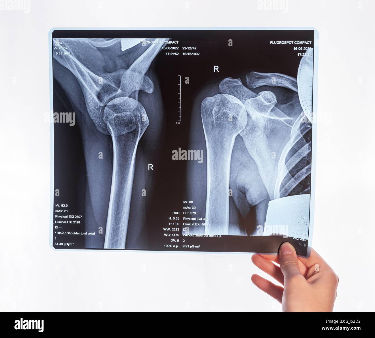 Hand holding shoulder, clavicle X-ray image. Acromion, acromial end fracture. Arm injury. Health care, medical imaging concept. Radiography. High quality photo Stock Photo