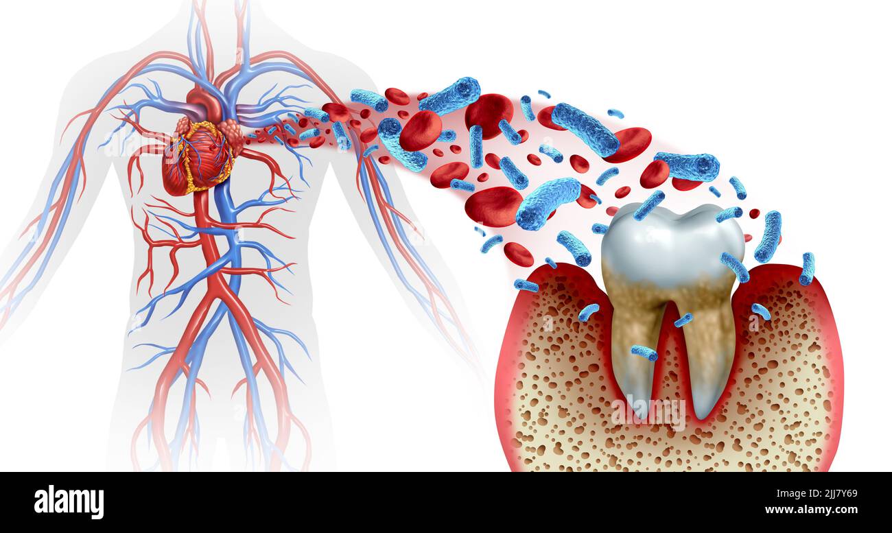 Tooth decay and heart disease as an unhealthy molar with periodontitis due to poor oral hygiene health problem as a bacteria infection in the blood. Stock Photo