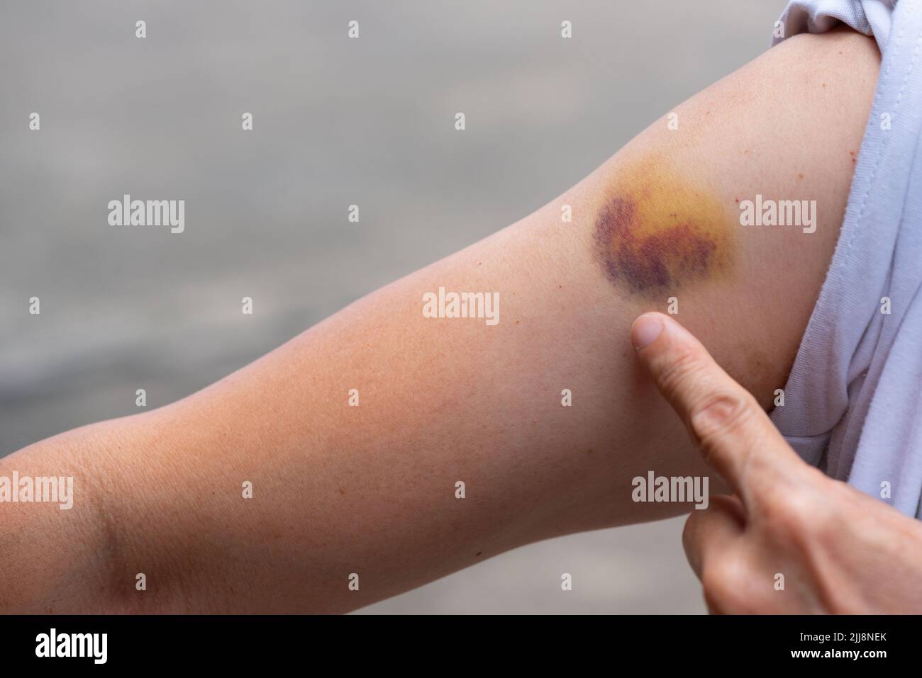 Bruise from blunt trauma on a woman right arm Stock Photo