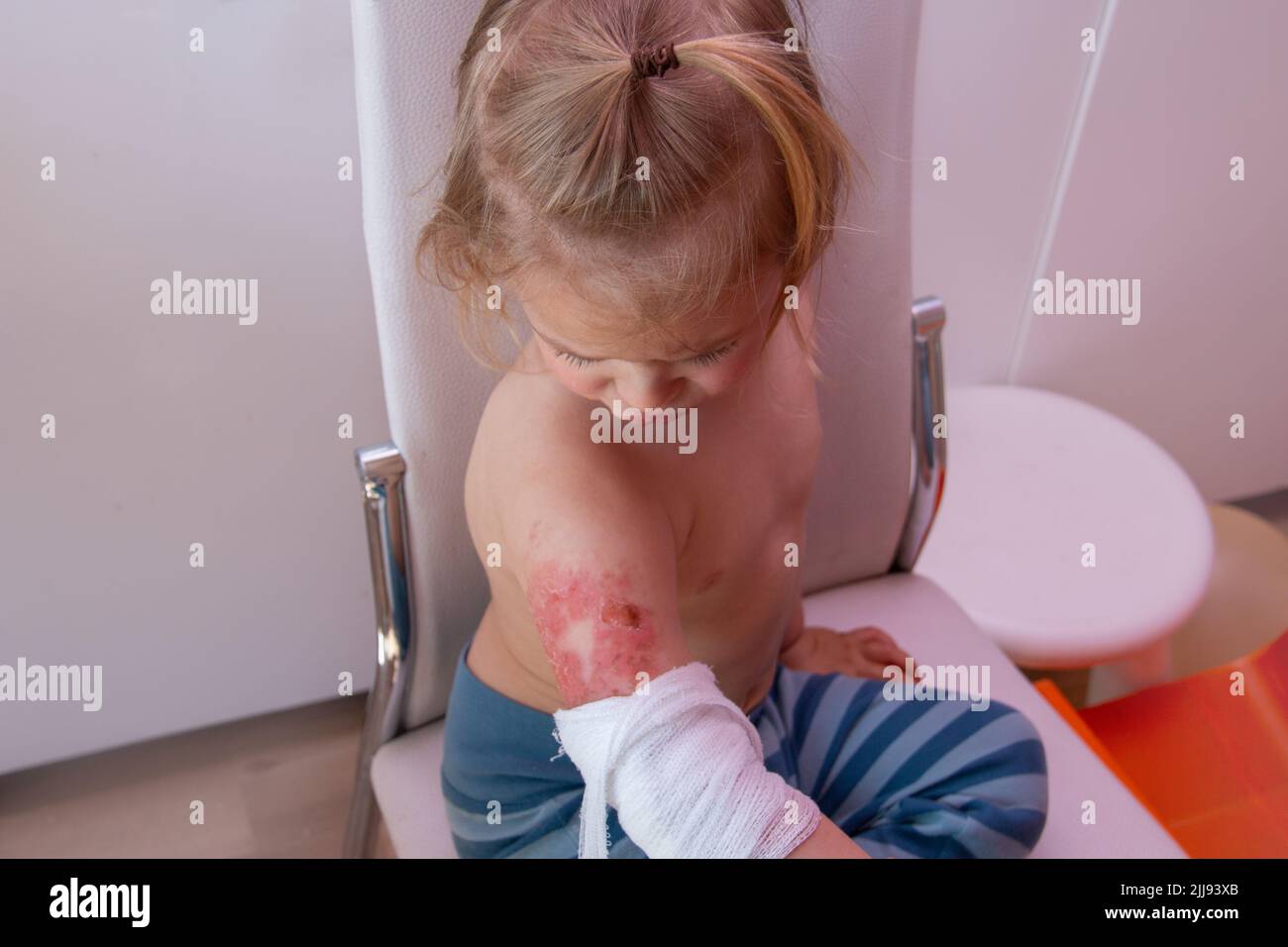Toddler with burned wound on arm, children accidents, pediatric burns and scalds Stock Photo