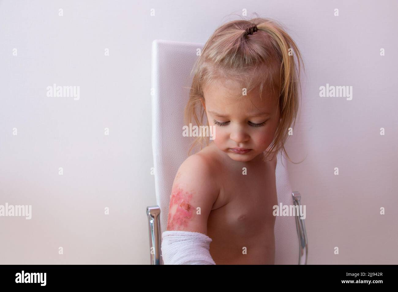 Toddler with burned wound on arm, scalds and burns in a child, empty space Stock Photo