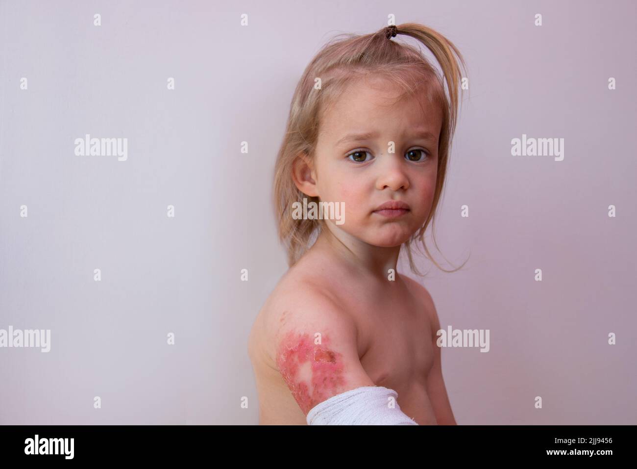Burned arm of a little child, children burns injuries, cute trouble boy toddler with second- degree scald, copy space background Stock Photo