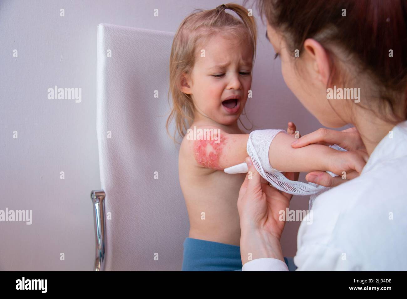 How to treat child burn, treating pediatrics burn wounds in children ...