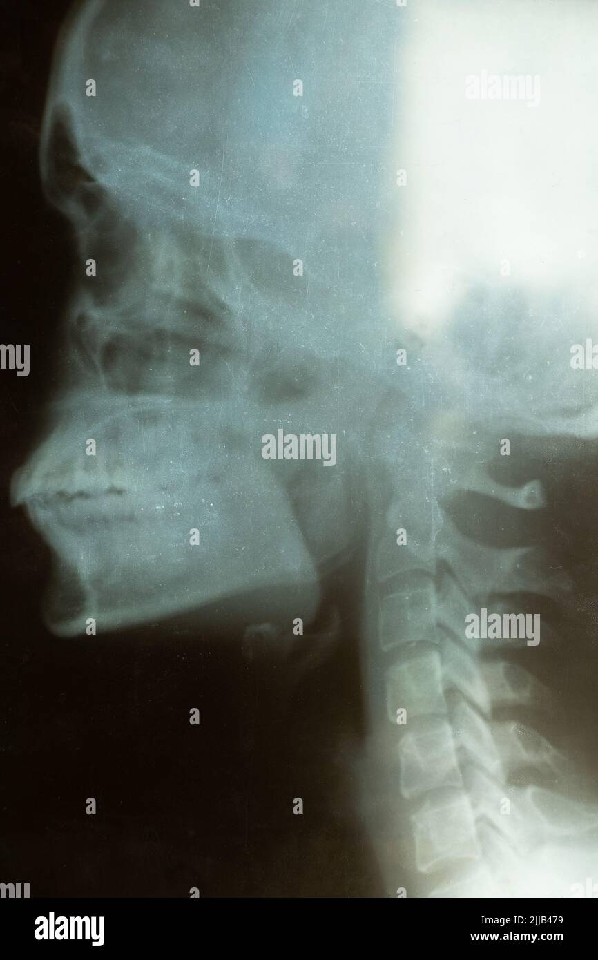 Old xray of a female skull closeup, examination of the skull