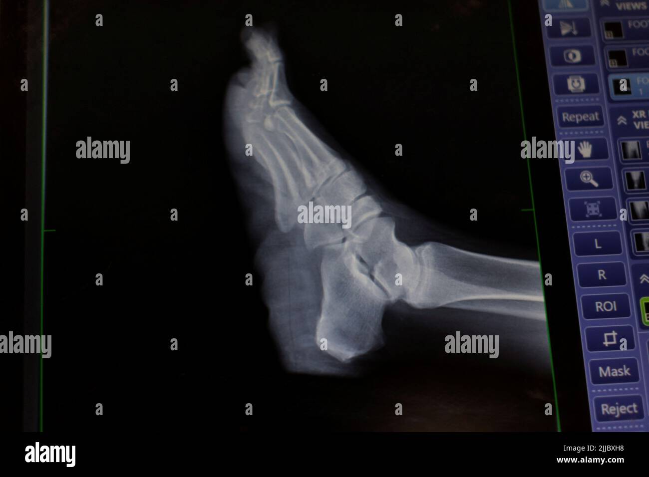 The X-rayed foot of an injured border wall fall patient appears on a mobile X-ray unit as she is treated at Scripps Mercy Hospital’s trauma unit in San Diego, California, U.S., May 25, 2022.   REUTERS/Mike Blake Stock Photo