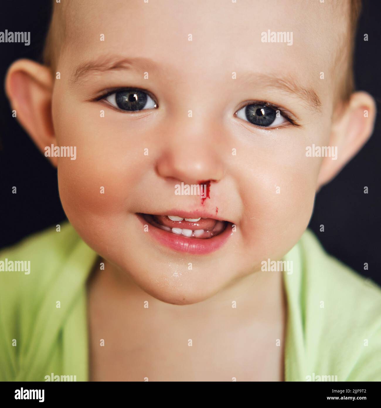 Happy toddler baby boy with a bloody nose. Bleeding from the nose of a
