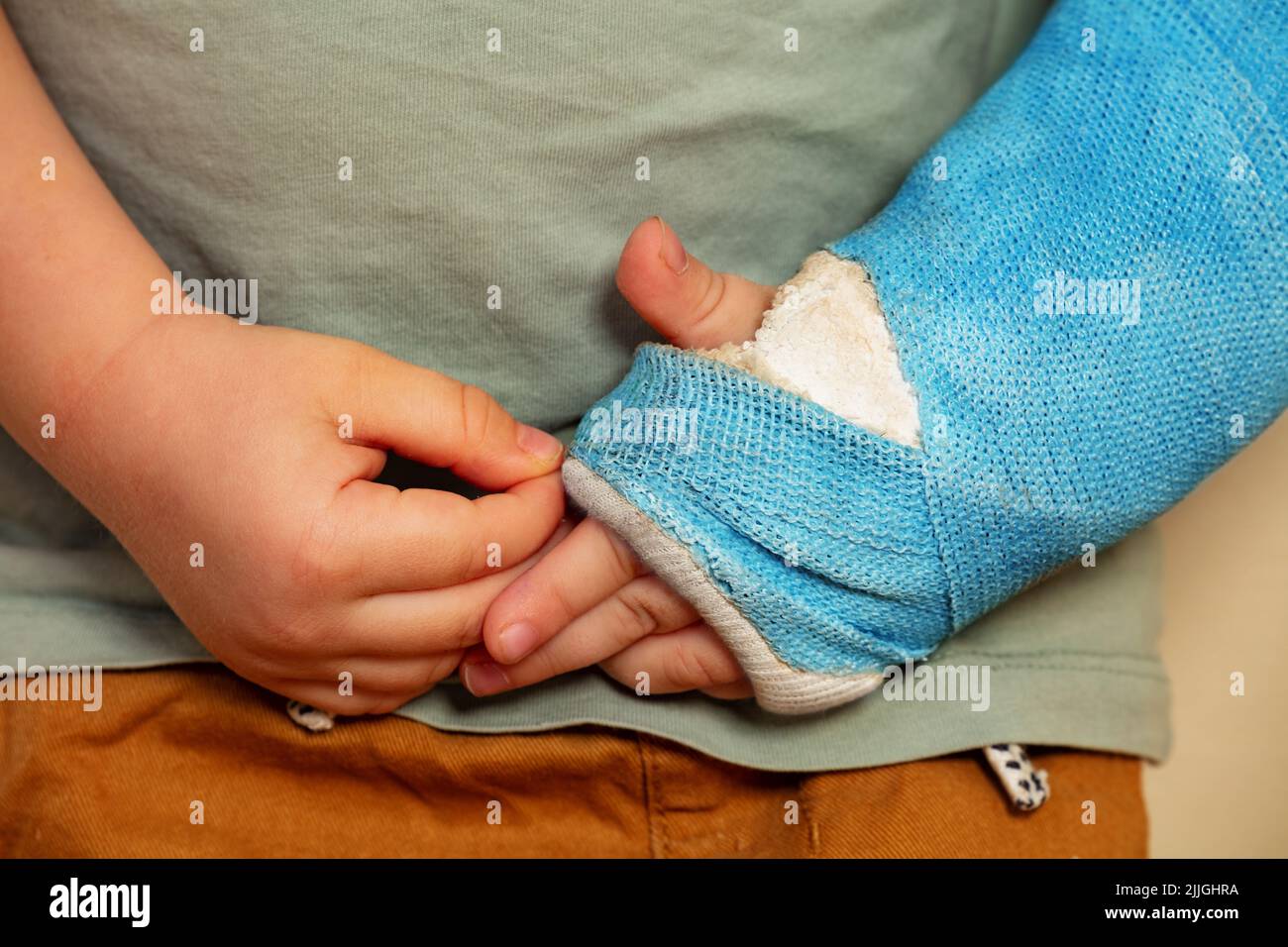 Closeup of a broken hand blue plaster cast after accident torching