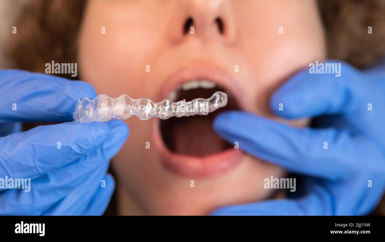Orthodontist doctor in gloves putting silicone invisible transparent braces on woman's teeth in dentist clinic, mouth closeup view. Correcting teeth t Stock Photo