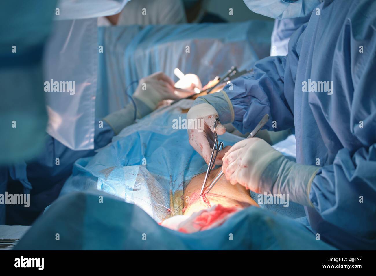 Team Of Professional Doctors Operating A Patient Conducting Open Cut 
