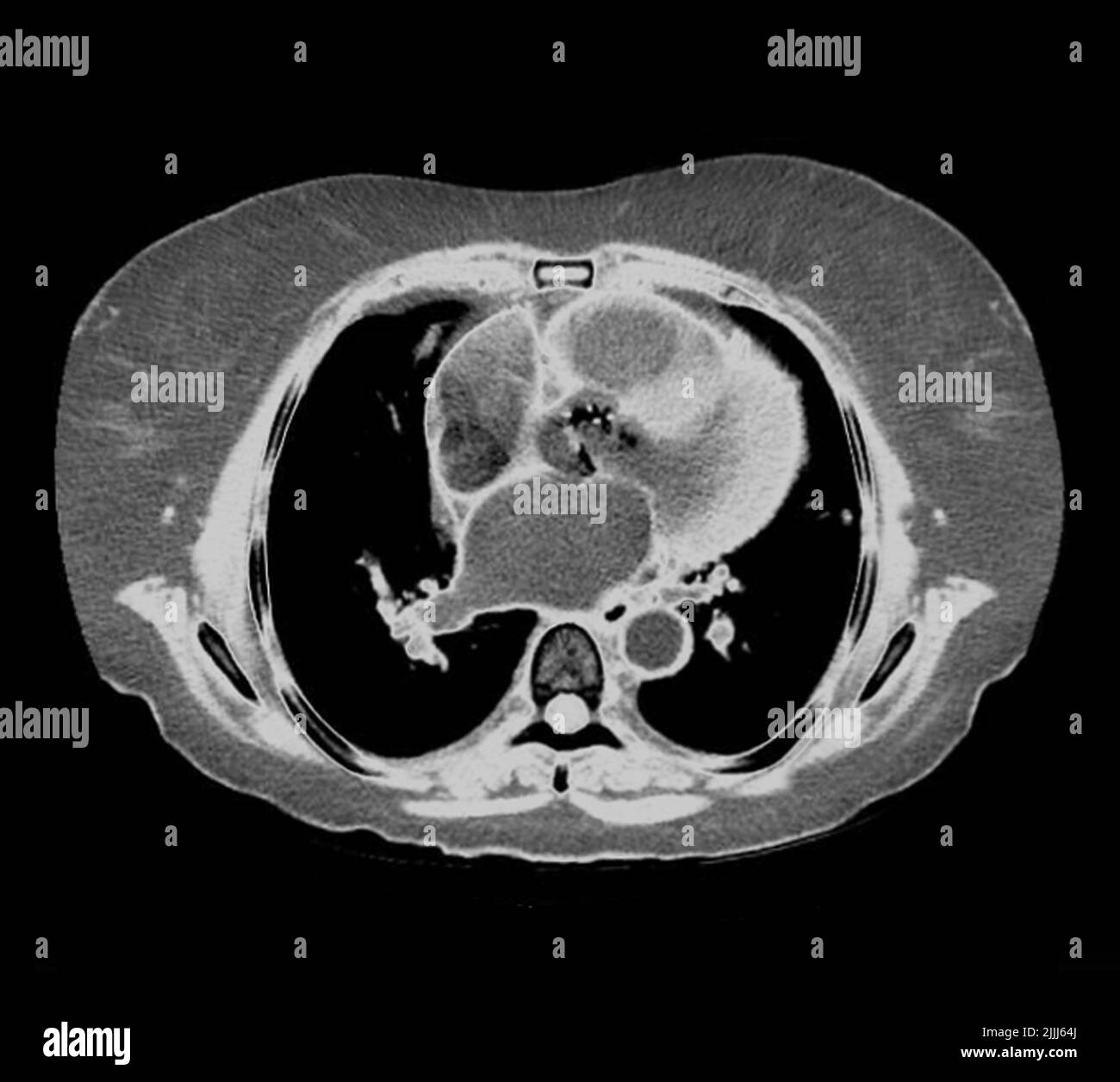 Heart failure, CT scan Stock Photo Alamy