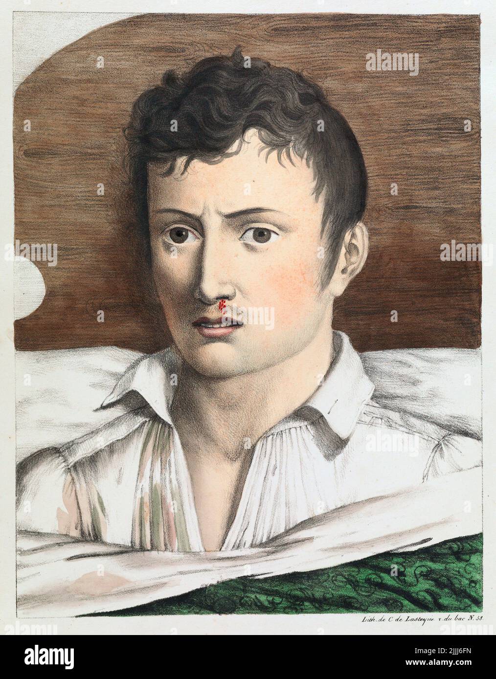 Patient with yellow fever, illustration Stock Photo Alamy