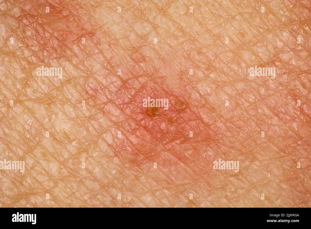 Shingles, Herpes Zoster, Germany Stock Photo