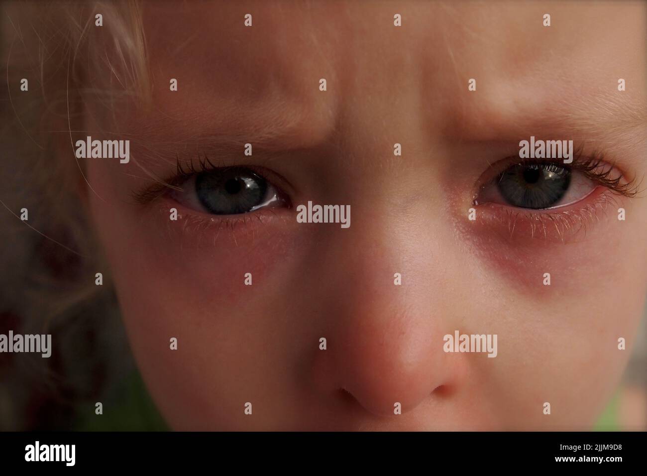 Bloodshot Eyes From Crying