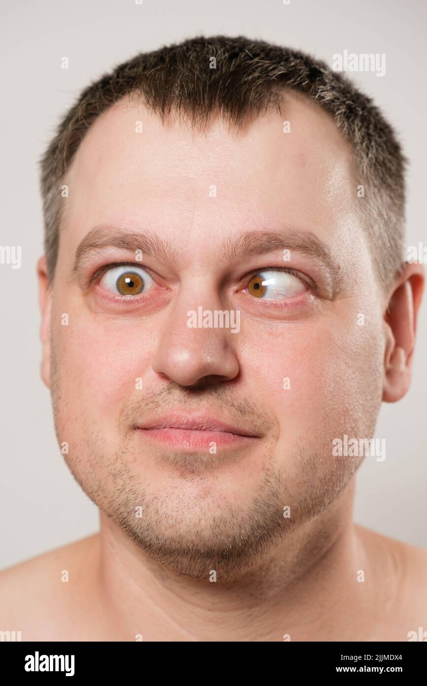 A man with strabismus squints his eyes on a white background. Stock Photo