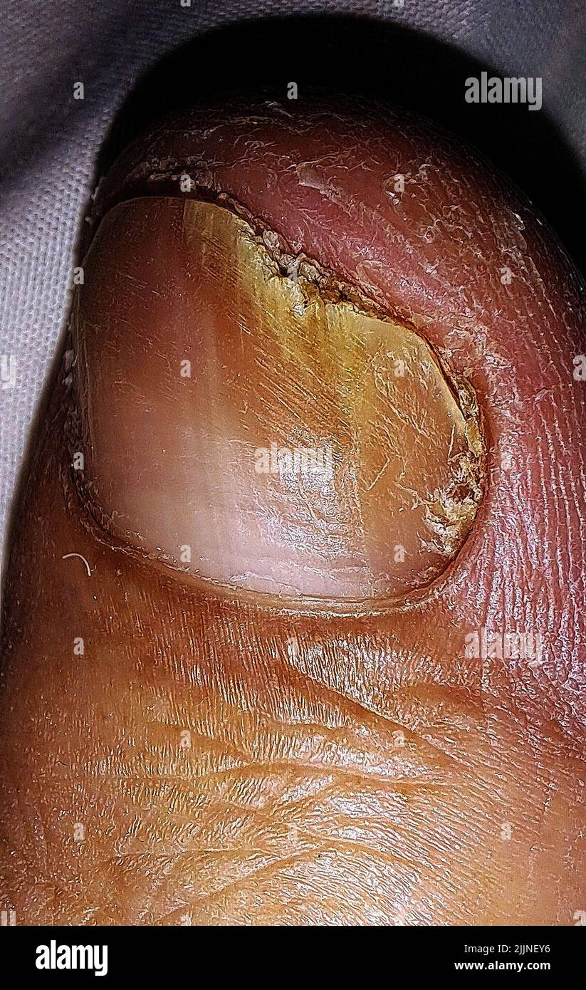 July 26, 2022: July 27, 2022, Nail fungus is common and begins as a white or yellow spot under the tip of a fingernail or toenail. As the fungal infection deepens, the fungus can cause discoloration and thickening of the nail, as well as deterioration of the nail edge. It may affect several nails.Photo: Juan Carlos Hernandez (Credit Image: © Juan Carlos Hernandez/ZUMA Press Wire) Stock Photo