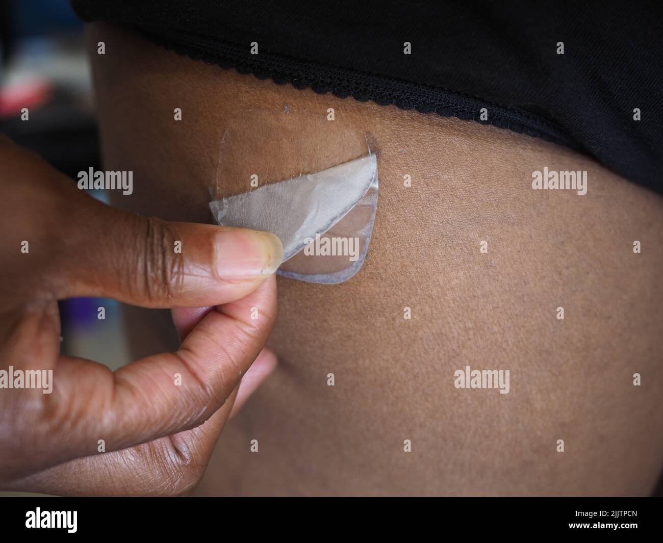 HRT Patch being peeled from the skin of a woman of colour Stock Photo