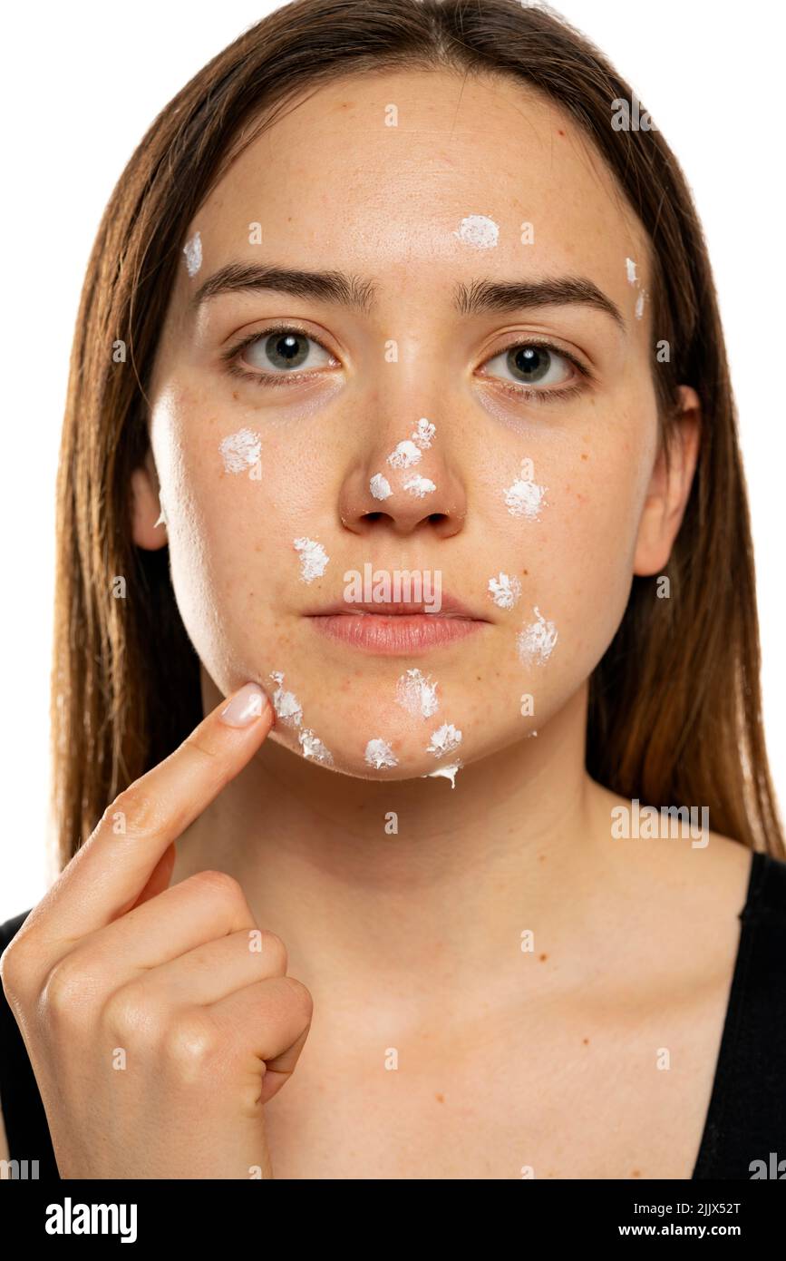 Woman applying acne cream on her face for solving acne inflammation on