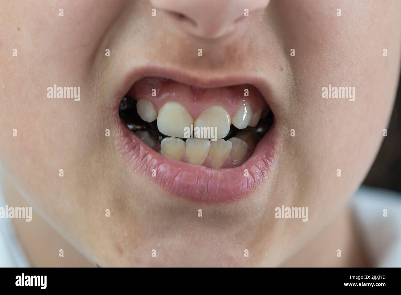 Adult permanent teeth coming in front of the child baby teeth: shark teeth. Little girl's open mouth. consultation of dentist. problem. Stock Photo