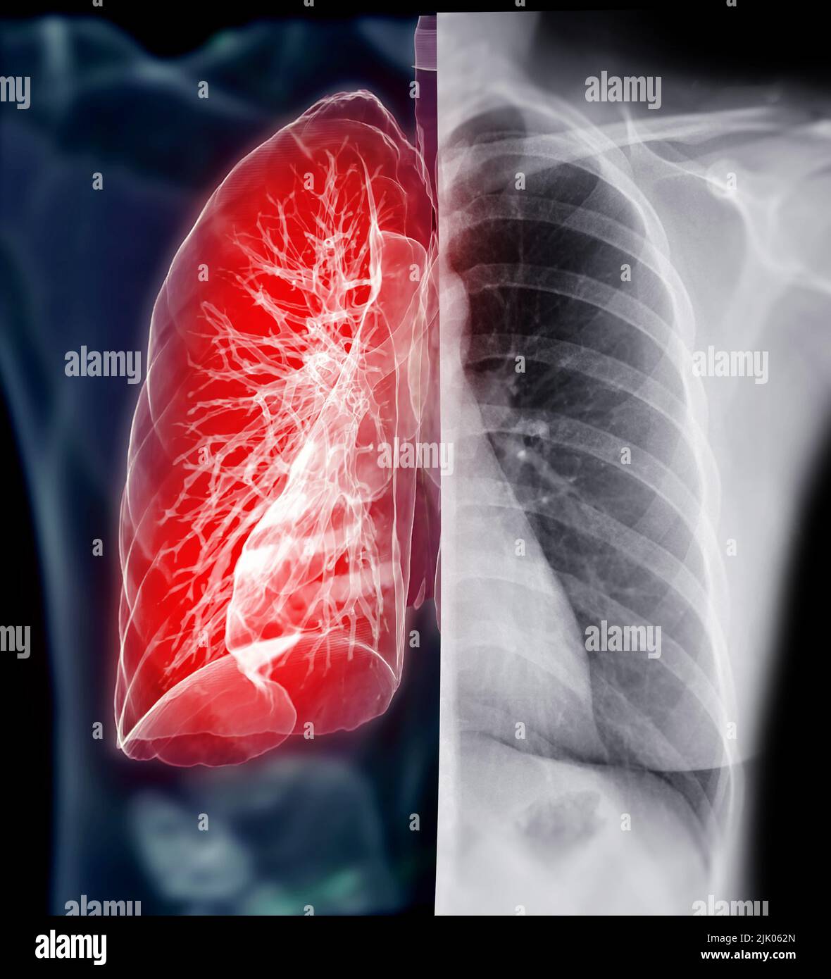 Chest Xray with Lung 3D rendering for diagnosis TB,tuberculosis and