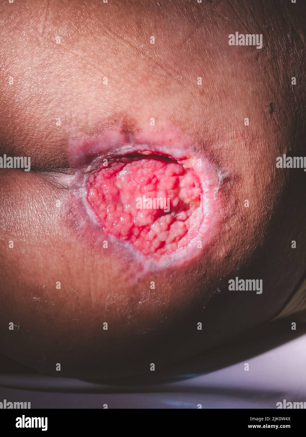Pressure injury stageIV.Bedsore pressuresore bedridden.HealthCare and Medical Concept. Stock Photo