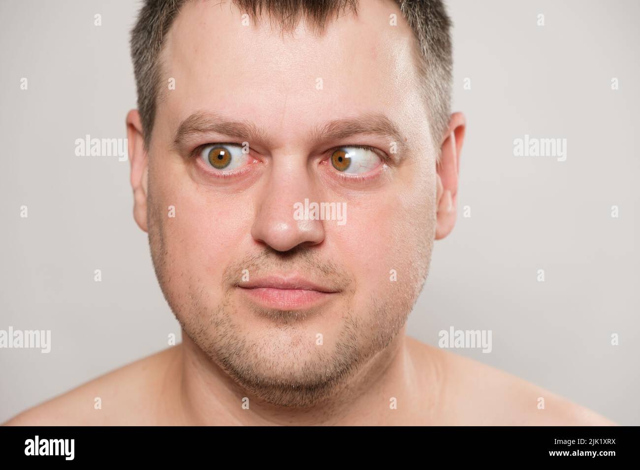 A man with strabismus squints his eyes on a white background Stock Photo