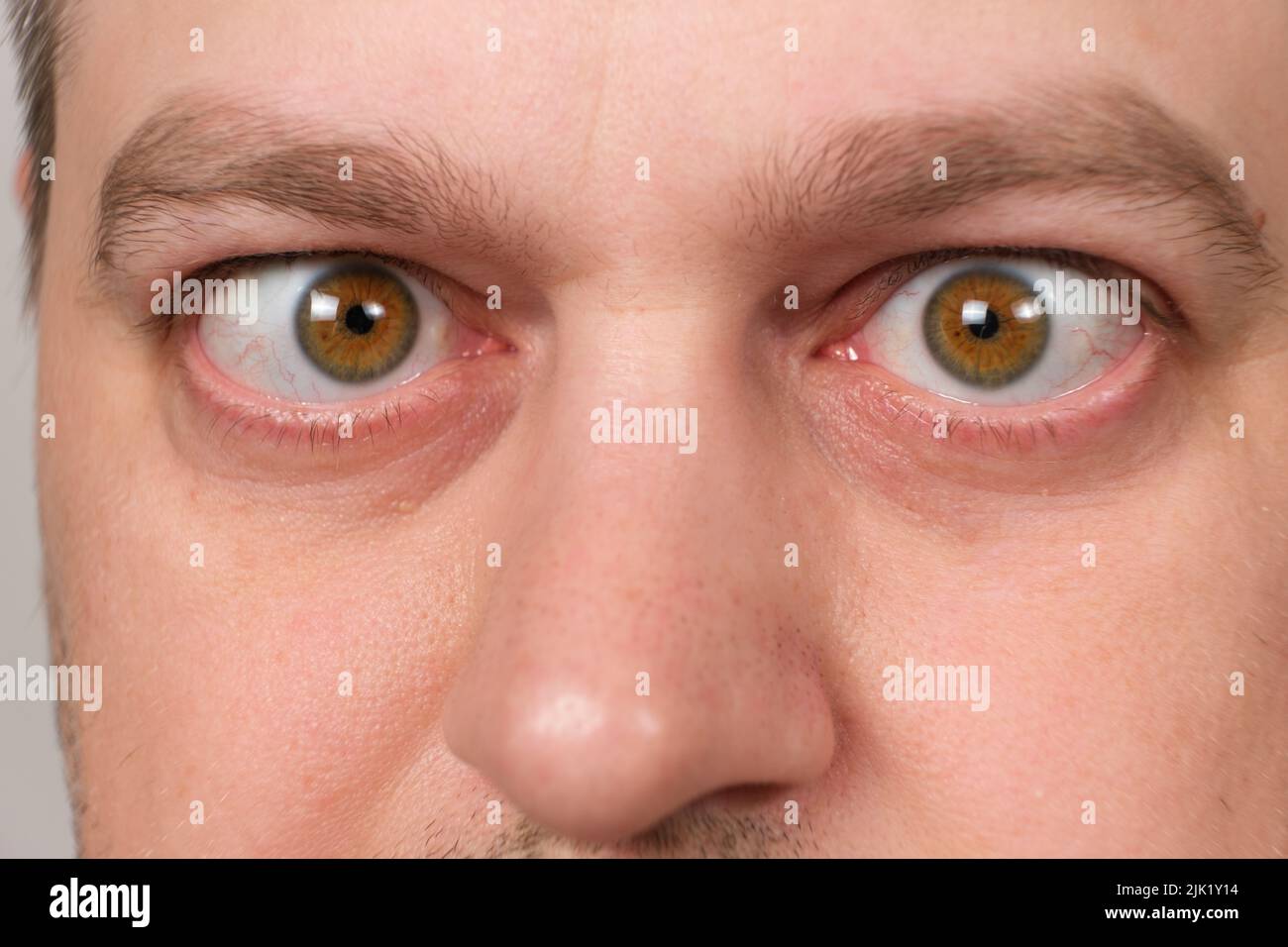 A man with strabismus squints his eyes on a white background Stock Photo