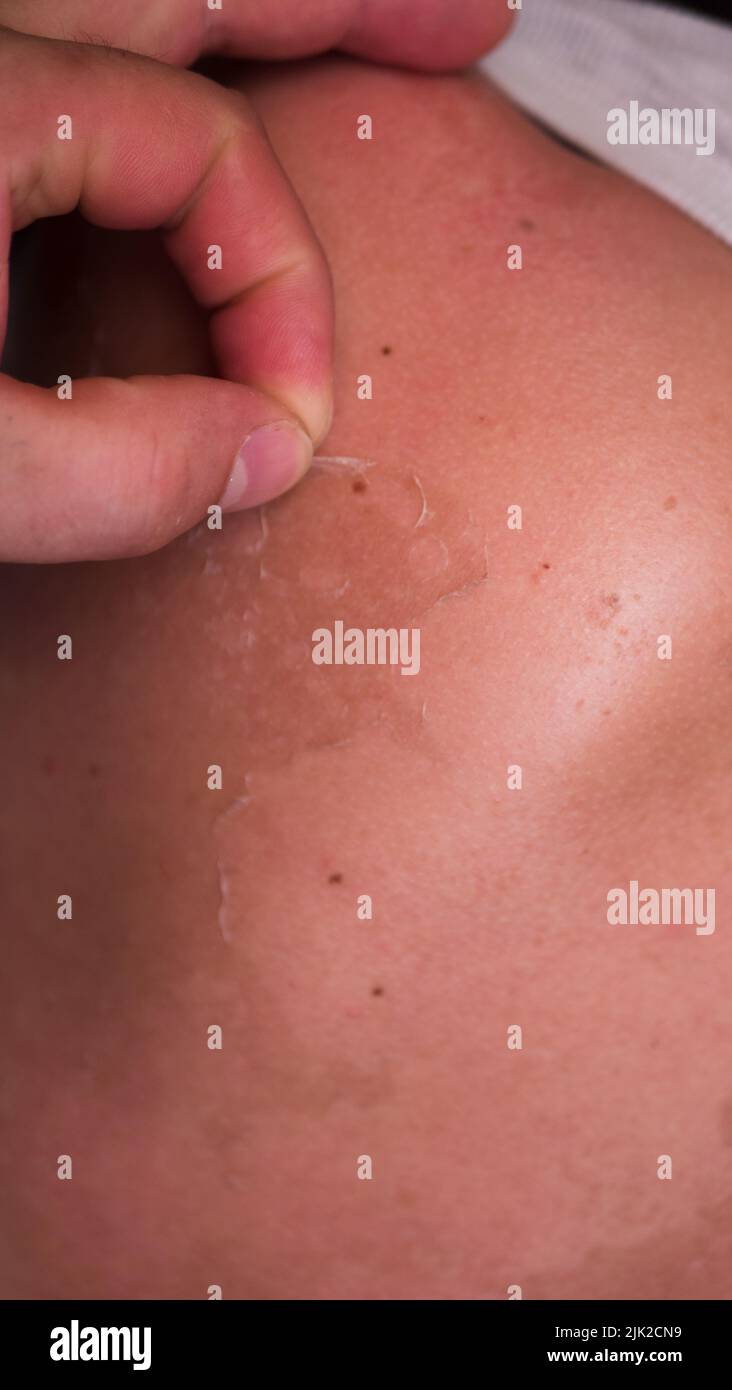 Exfoliation of the skin after sunburn. Excessive tan. The effects of sunburn on the skin. Climb skin Stock Photo