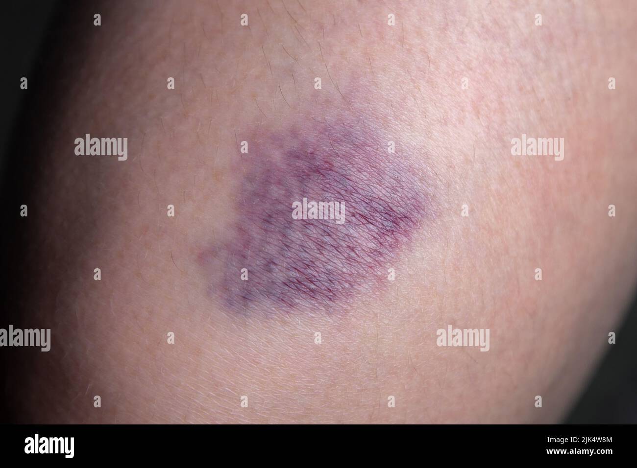 Image of the bruise on woman leg Stock Photo