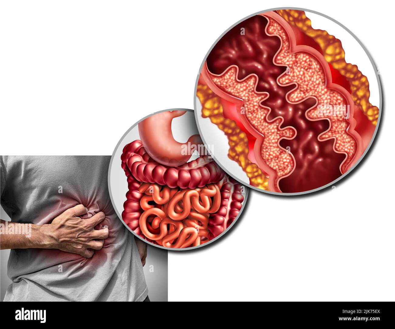 Crohn's disease pain and Crohn syndrome illness or crohns disorder as a medical concept with a close up of a human intestine with inflammation. Stock Photo