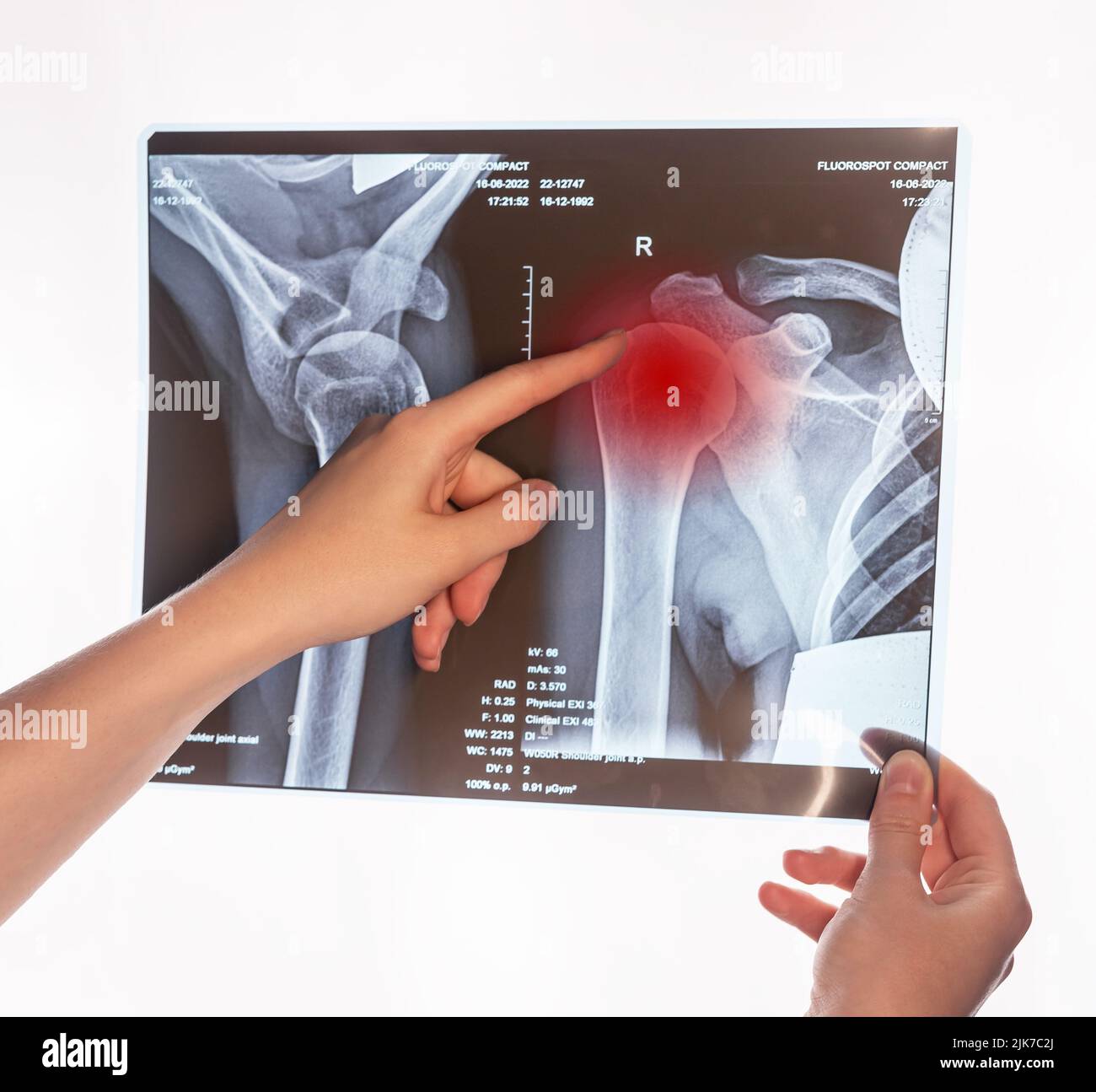 Forefinger pointing to trauma at arm X-ray image with red point. Acromion, acromial end fracture. Doctor showing shoulder, clavicle injury. Broken collarbone, overuse, dislocation. High quality photo Stock Photo