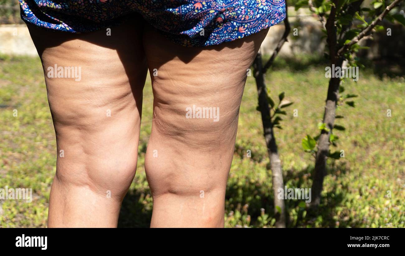 Fat leg hi-res stock photography and images - Alamy