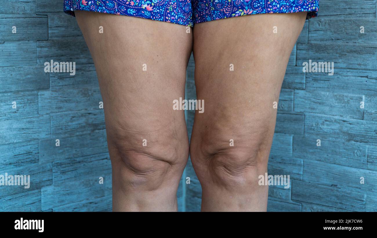 Cellulite on woman leg. Close-up of cellulite leg. Body treatment concept. Stock Photo