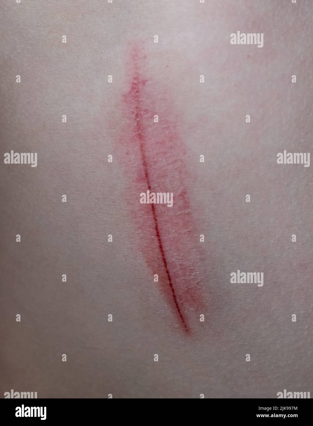 Skin abrasion or scratch on the abdomen. Medical abrasion, injury or