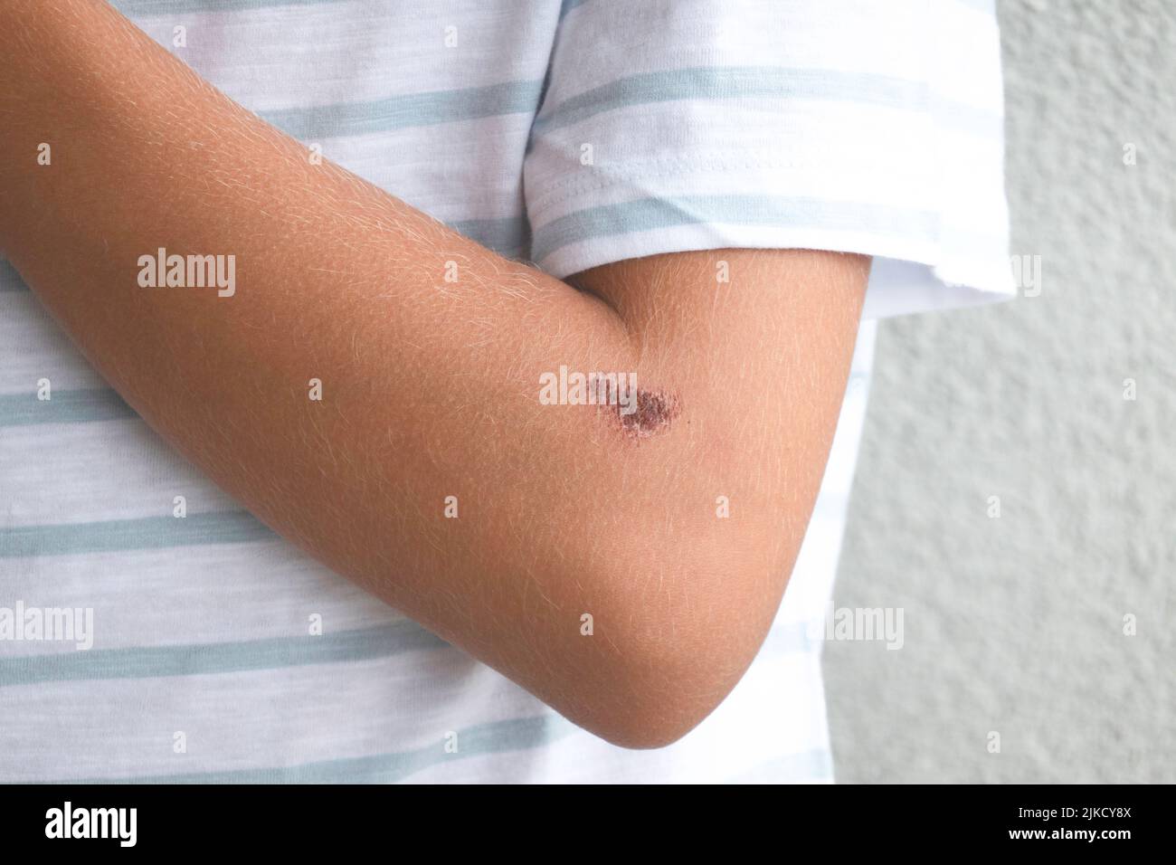 Healing wound on child hand. Deep scratches on teenage boy elbow hand ...