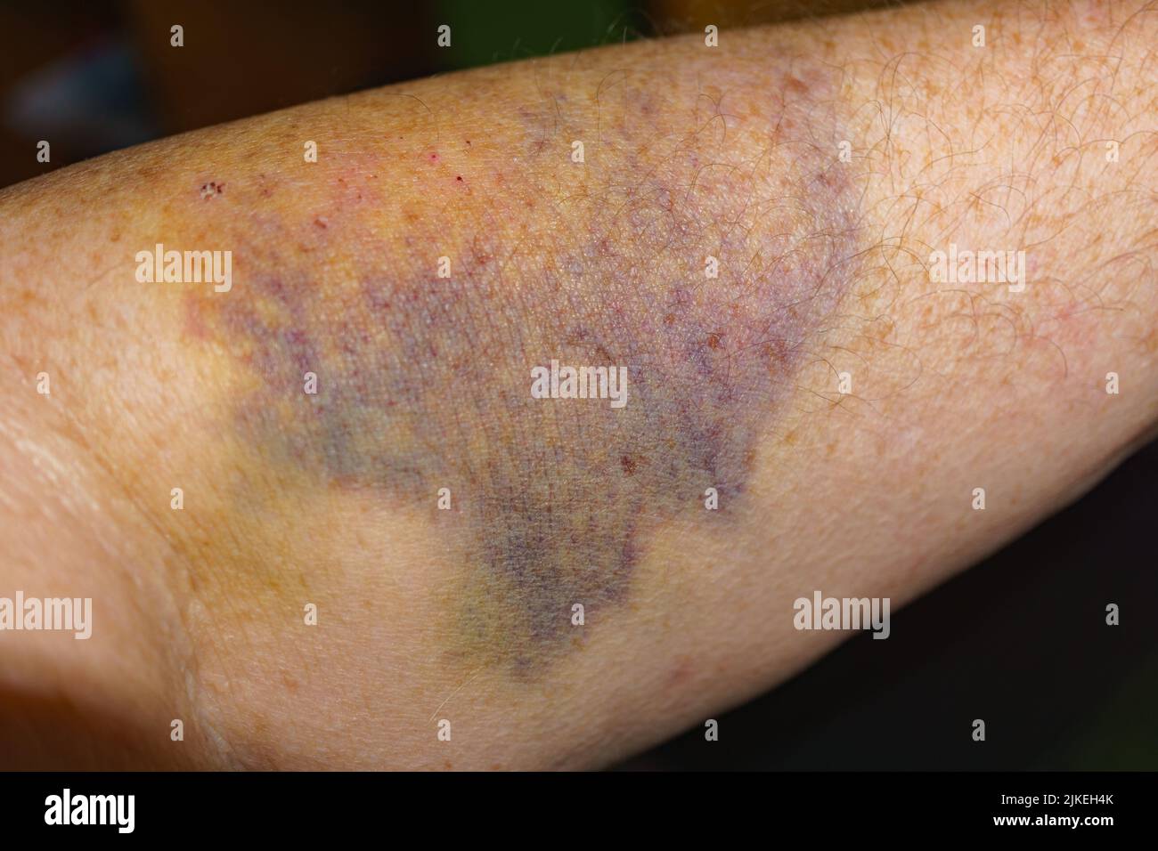 bruise-healing