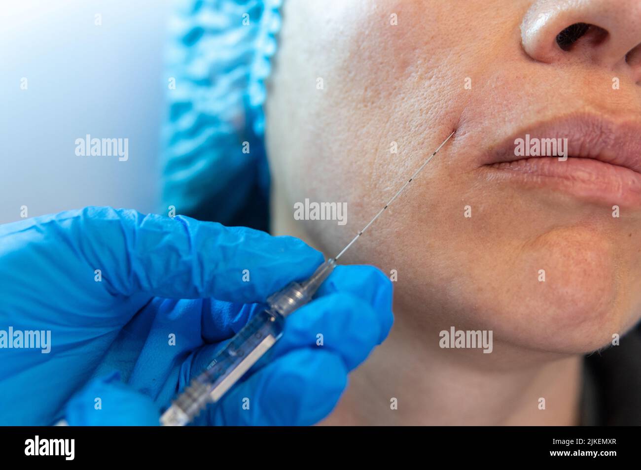 closeup of a syringe in a beautifying treatment applying hyaluronic acid to a person next to the lips Stock Photo