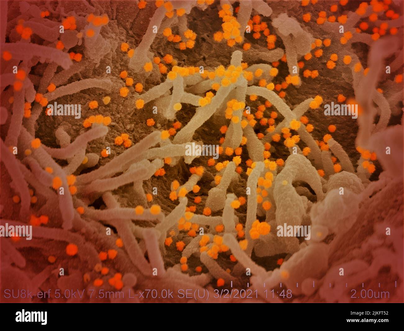 This scanning electron microscope image shows SARS-CoV-2 (round orange particles) emerging from the surface of a cell cultured in the laboratory. SARS Stock Photo