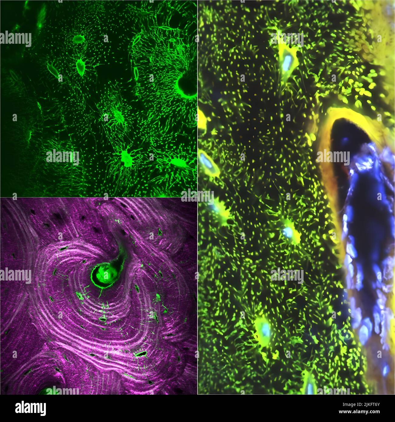 More than just a rigid organ, bone is porous and has living cells. Knowing the structure of bone is key to understanding how nutrients are delivered and the signals transmitted between bone cells. Using fluorescence, the network of bone cells is imaged under a microscope. The vast branch-like structures (upper left) are dependent highways of isolated bone cells. And bone cells form a solar system-like structure, following pink traces of collagen in cross sections (bottom left). Stock Photo