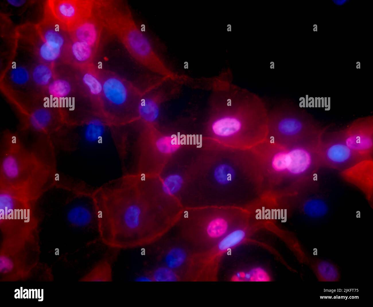 The image shows a cell culture of conditionally reprogrammed human breast cancer cells. The fluorescent red color represents MHC-I and the nuclei are shown in blue. Stock Photo