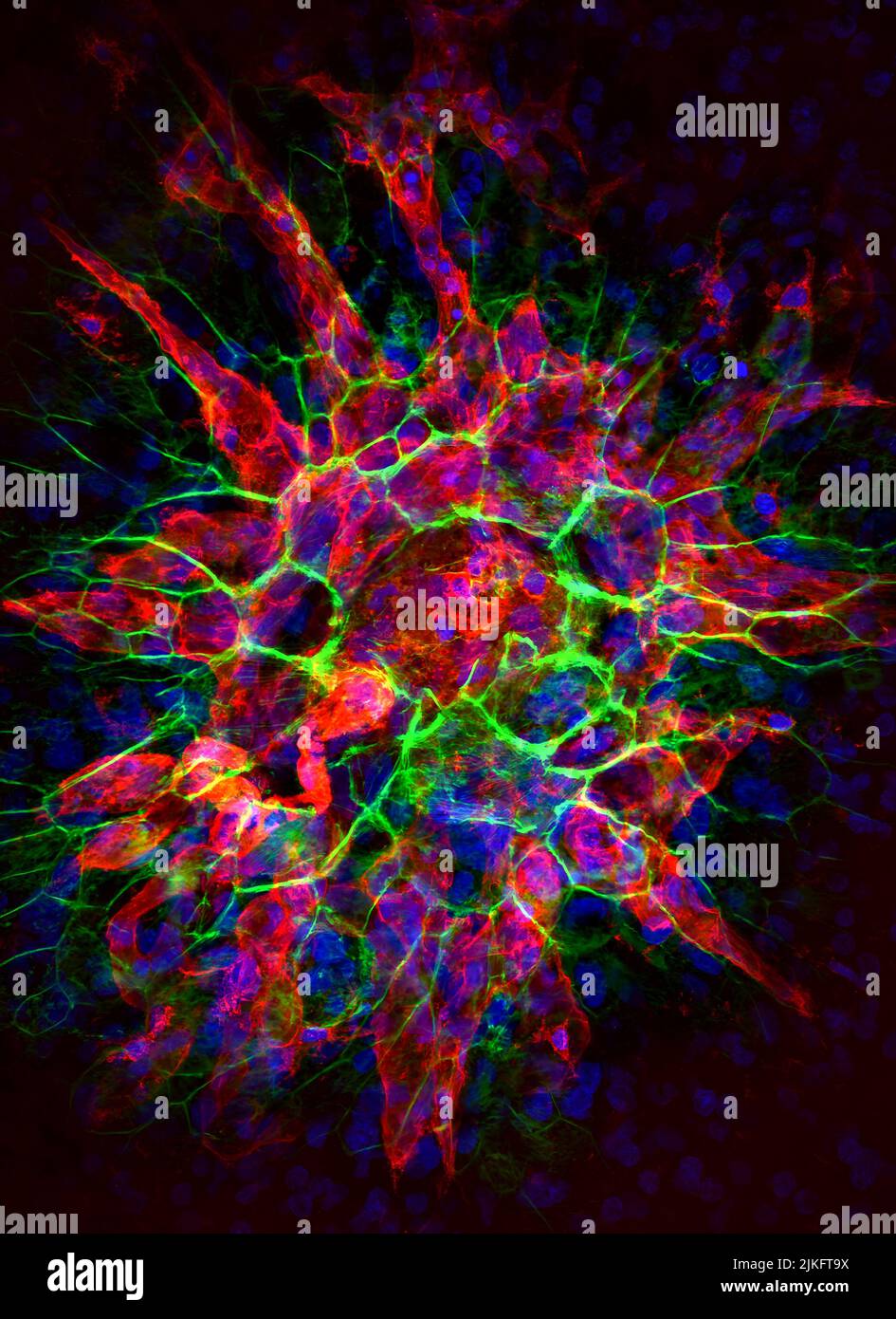 Neovascularization is common in people with age-related macular degeneration. In patients with AMD, the neovascularization threatens vision and is often treated with drugs to slow or stop the growth of new blood vessels. Stock Photo