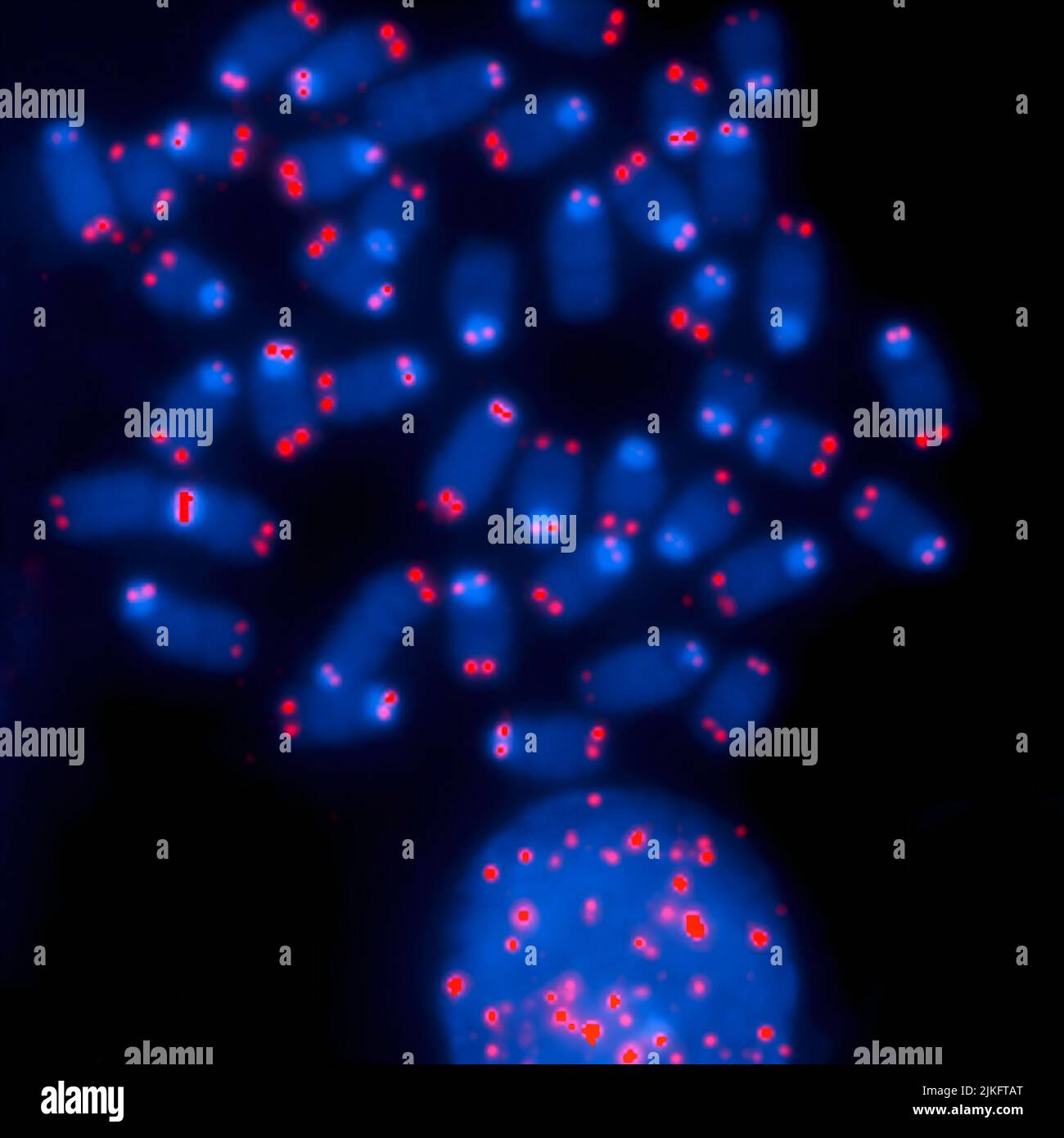 The supplied chromosomes are protected by specific DNA sequences called telomeres, shown here in red. This image shows that some chromosomes lack telomeres, which can lead to abnormal cell division and cancer. Stock Photo