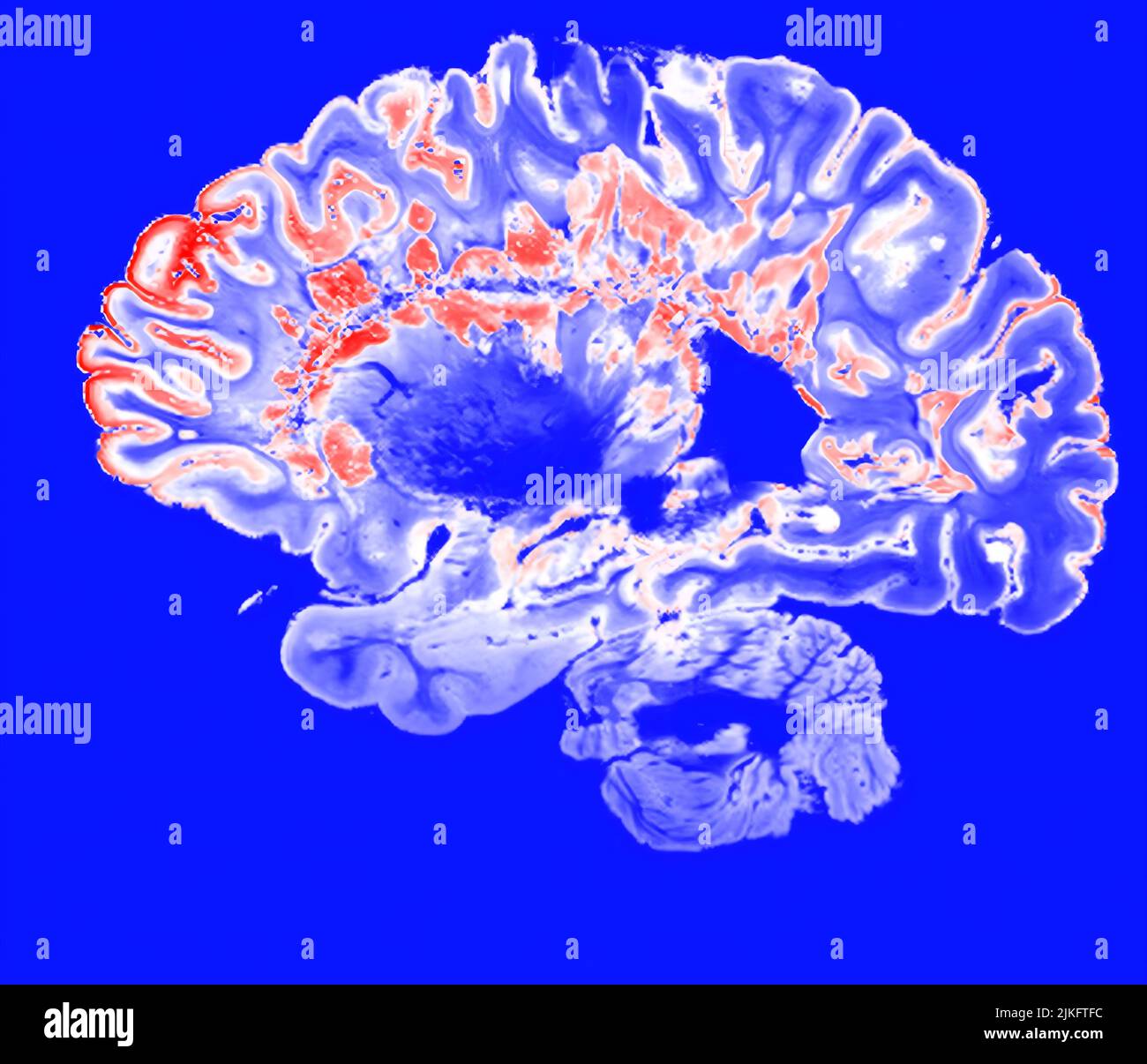 This is a pseudo-colored image of a high resolution gradient echo MRI of a fixed cerebral hemisphere of a person with multiple sclerosis. Stock Photo