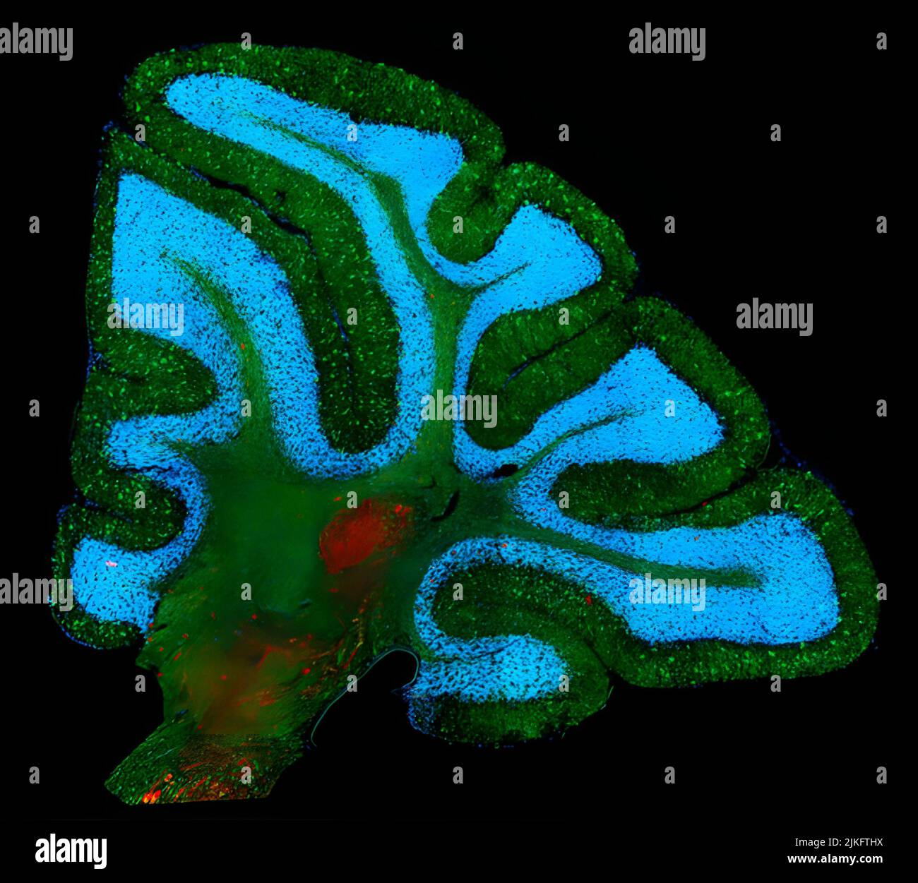 NiemannPick disease type C1, a lipid storage disorder, as seen in a