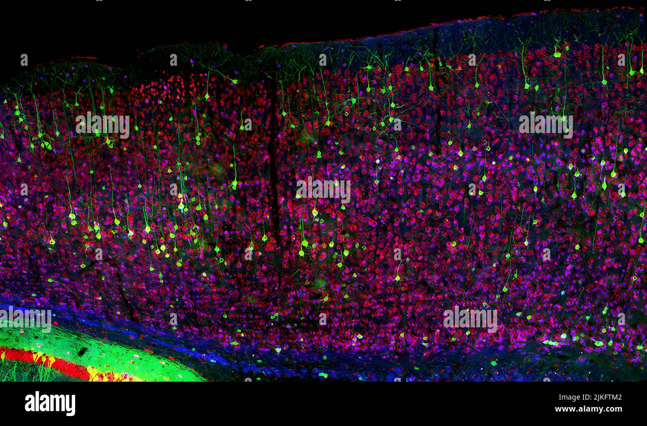 Close-up of neurons in a mouse with Niemann-Pick type C1 neurodegenerative disease. A major way to assess the impact of a therapeutic potential on the central nervous system is to assess cerebellar pathology in mice. Stock Photo