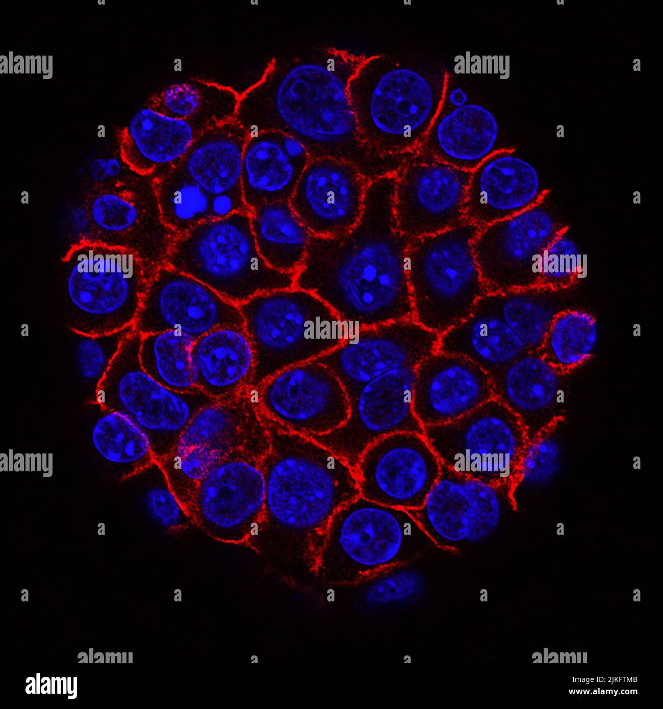 This scanning electron micrograph (SEM) depicted a number of red blood  cells found enmeshed in a fibrinous matrix on the luminal surface of an  indwelling vascular catheter; Magnified 11432x Note the biconcave