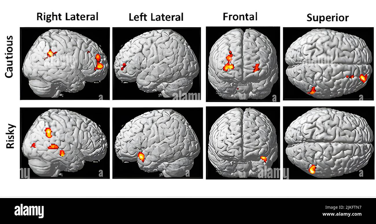 Many teens with substance use disorders take serious risks, including drunk driving, fighting, heavy drinking, injection drug use, and more. of such risks, researchers take pictures of the brains of typically developing adolescents and those with substance use disorder, as adolescents decide between engaging in safe or risky behavior. The first row in the figure above shows brain activity as children make decisions that lead to cautious behaviors. Stock Photo